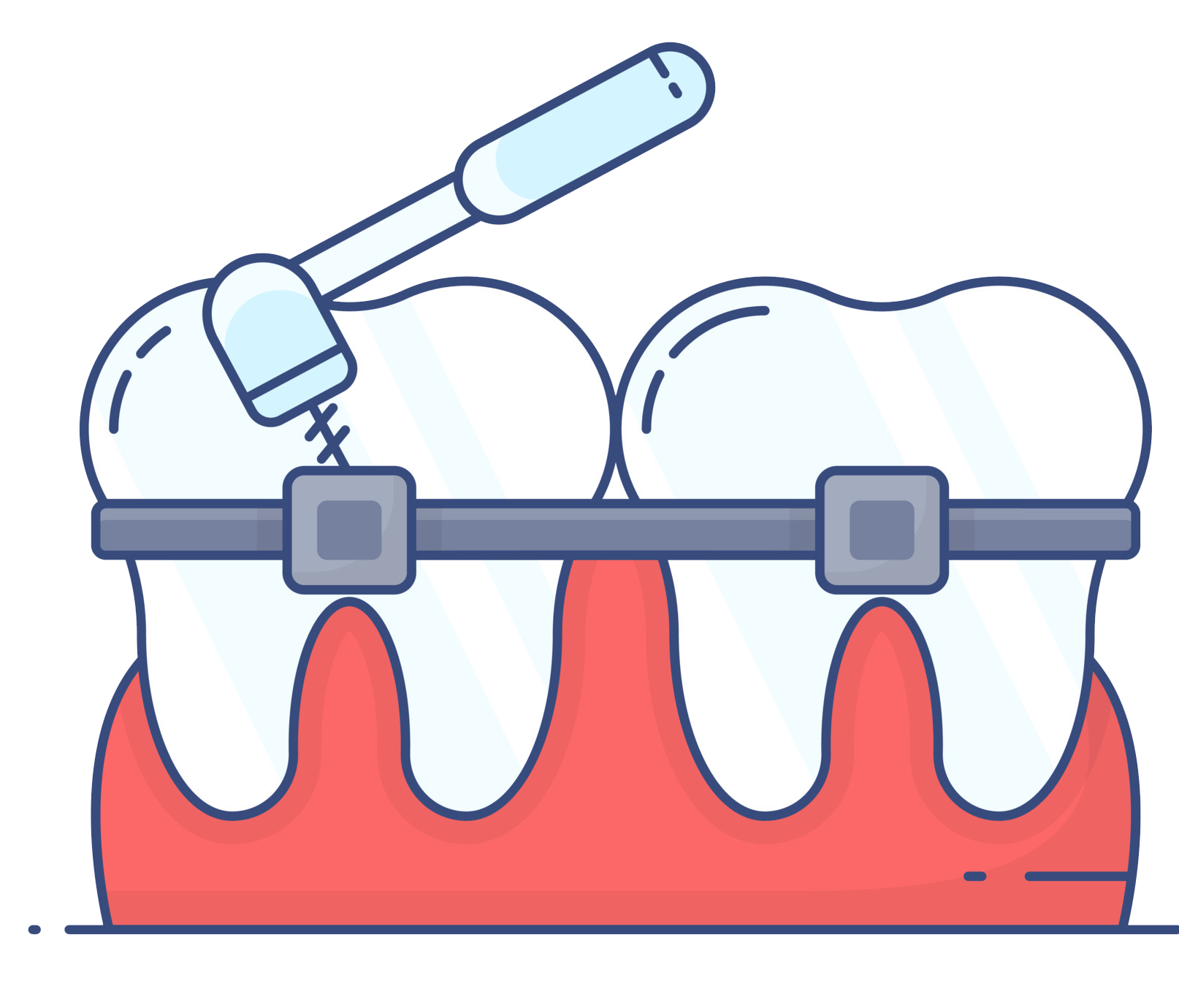 Ceramic Braces or Metal Braces