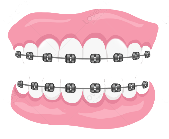 Clear Braces or Invisalign