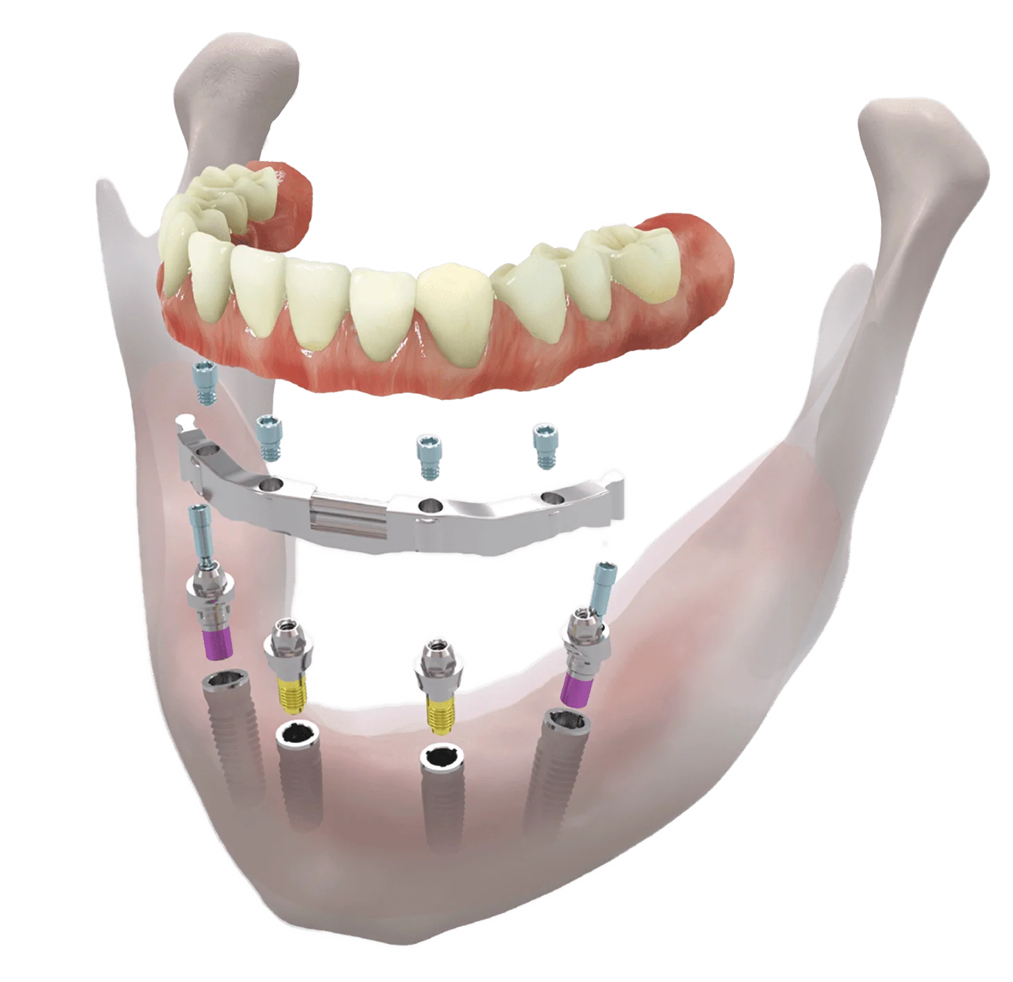 Fixed Denture