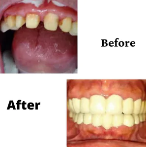 Invisible Aligners treatment in Bangalore