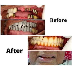 Invisible Aligners treatment in Bangalore