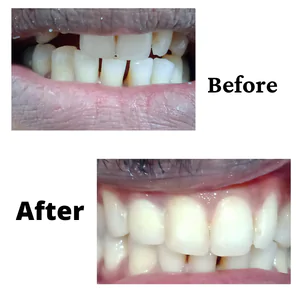 Invisible Aligners treatment in Bangalore