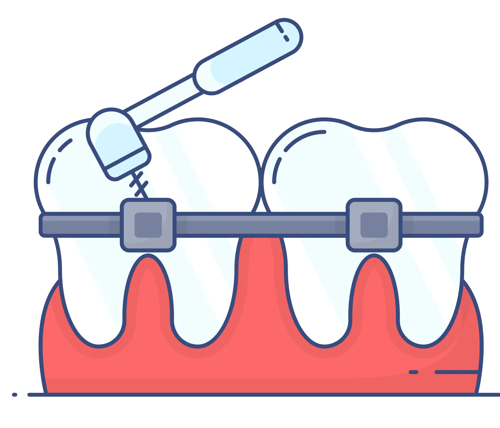 Ceramic Braces or Metal Braces