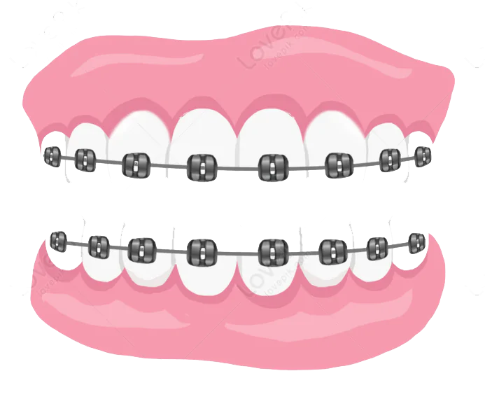 Clear Braces or Invisalign